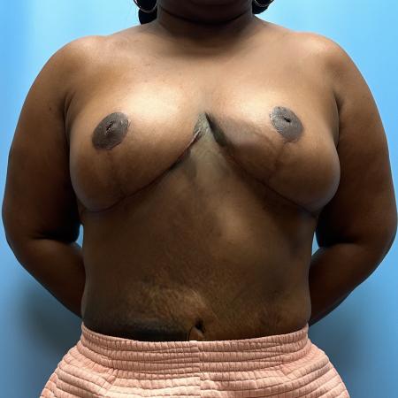 After image 1 Case #111371 - Breast Reduction 1