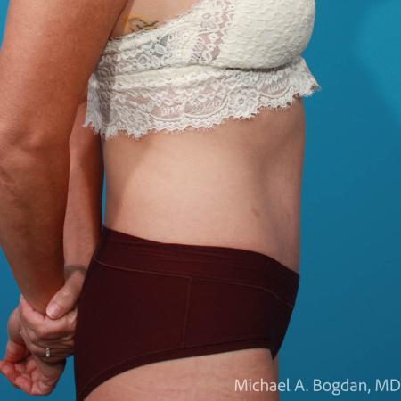 After image 3 Case #111916 - Abdominoplasty
