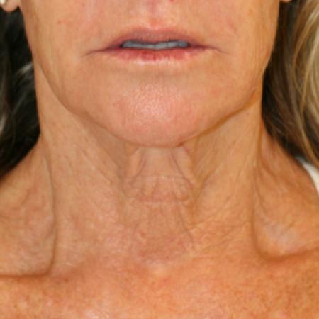 Before image 1 Case #111531 - Female Necklift