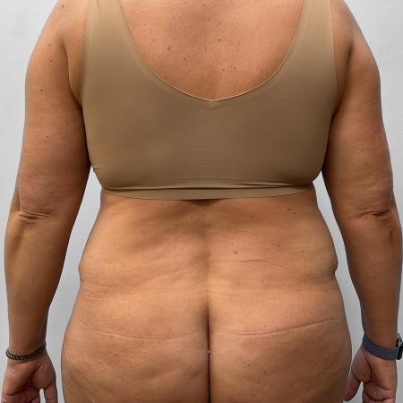 After Case #111431 - Tummy Tuck & Liposuction