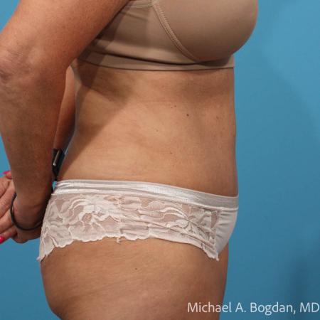 After image 3 Case #111801 - Abdominoplasty