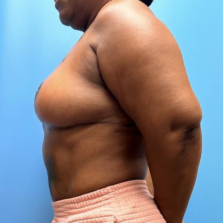 After image 3 Case #111371 - Breast Reduction 1