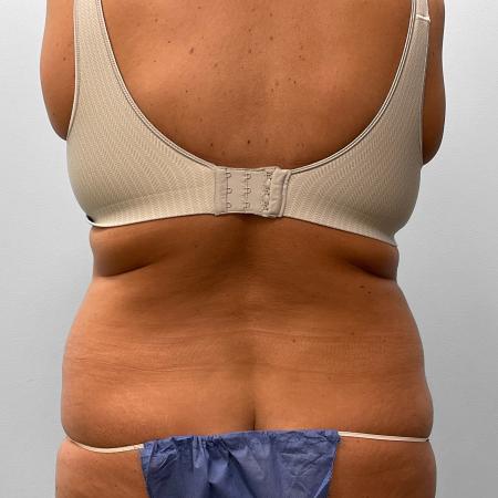 Before Case #111431 - Tummy Tuck & Liposuction