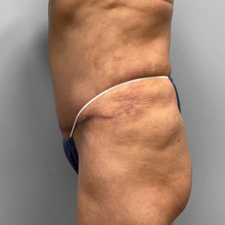 After Case #111851 - Tummy Tuck, Lipo, & BBL