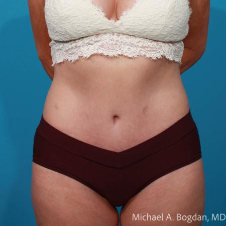 After image 1 Case #111916 - Abdominoplasty