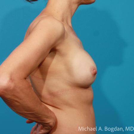 Before image 3 Case #111901 - Breast Implant Exchange