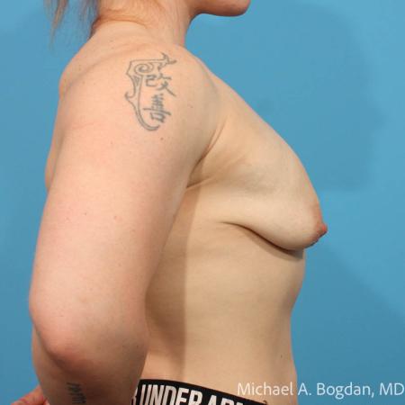 Before image 3 Case #111511 - Breast Augmentation
