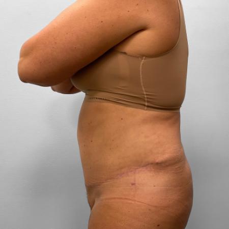 After Case #111431 - Tummy Tuck & Liposuction