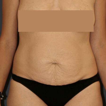 Before image 1 Case #111586 - Tummy Tuck (Abdominoplasty)