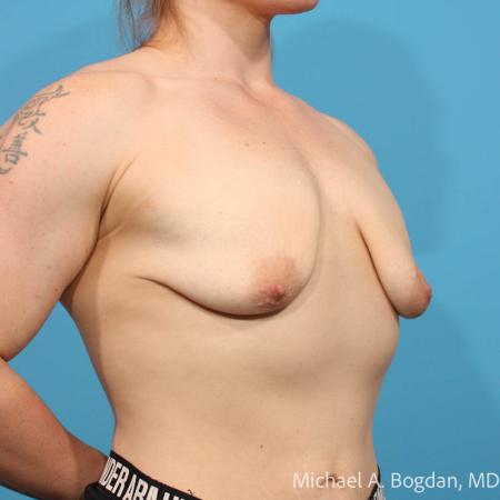 Before image 2 Case #111511 - Breast Augmentation