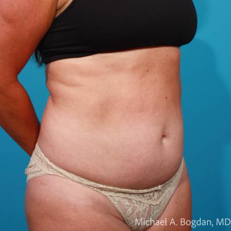 Before image 2 Case #111766 - Abdominoplasty