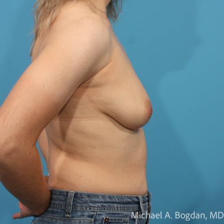 Before image 3 Case #111926 - Breast Augmentation