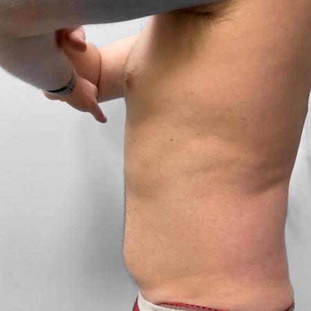 Before Case #111426 - Liposuction