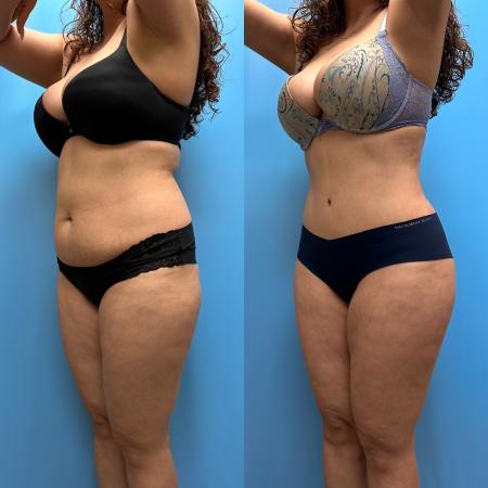 Before image 2 Case #110351 - Tummy Tuck, Lipo, Brazilian Butt Lift, Renuvion