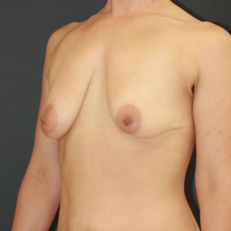 Before image 2 Case #111626 - Female Breast Lift with Fat Transfer
