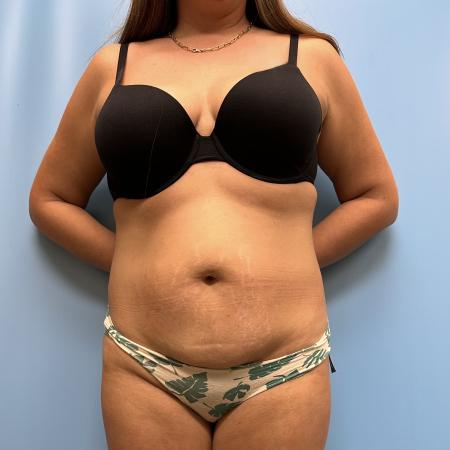 Before image 1 Case #111466 - Tummy Tuck with Lipo 360 2