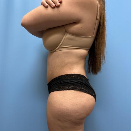 After image 3 Case #111601 - Tummy Tuck with Lipo 360 3