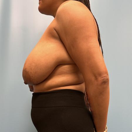Before image 3 Case #111456 - Breast Reduction 2