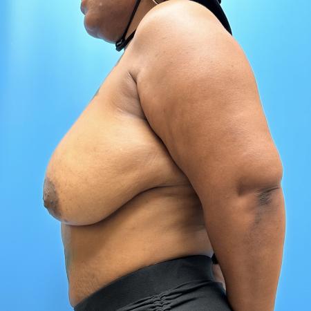 Before image 3 Case #111371 - Breast Reduction 1