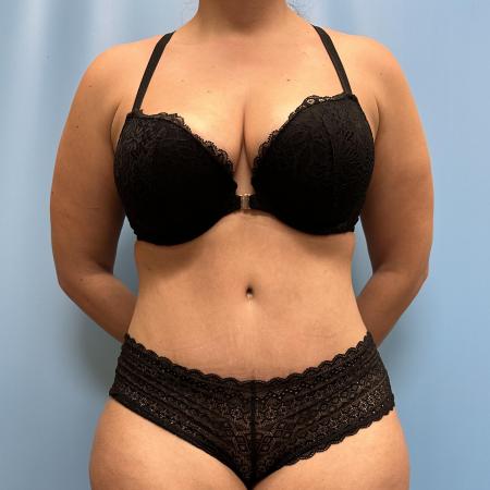 After image 1 Case #111461 - Tummy Tuck with Lipo 360