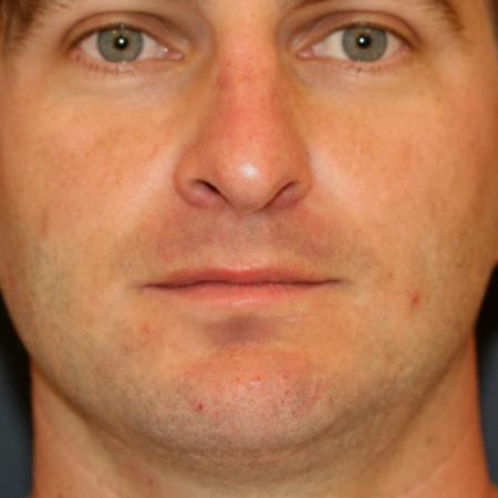 Before image 1 Case #111516 - Male Rhinoplasty with Chin Augmentation