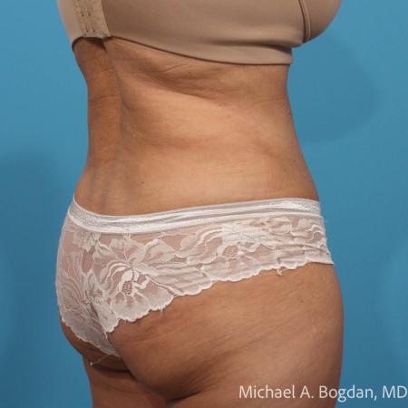 After image 4 Case #111801 - Abdominoplasty