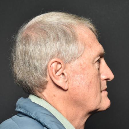 Before image 3 Case #111826 - Face and Neck Lift