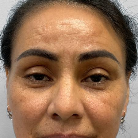 Before Case #111856 - Upper and Lower Blepharoplasty