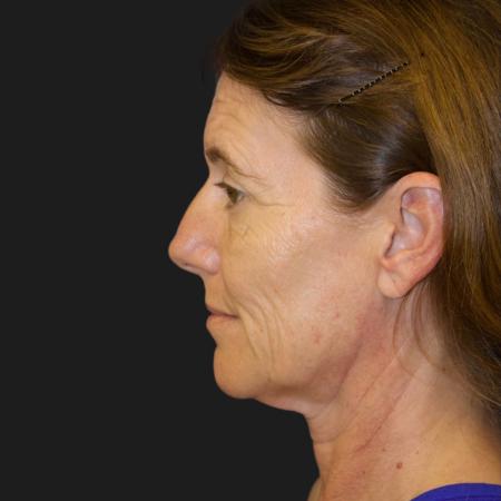 Before image 3 Case #111876 - 47 Year-Old Patient | Custom Facial Rejuvenation