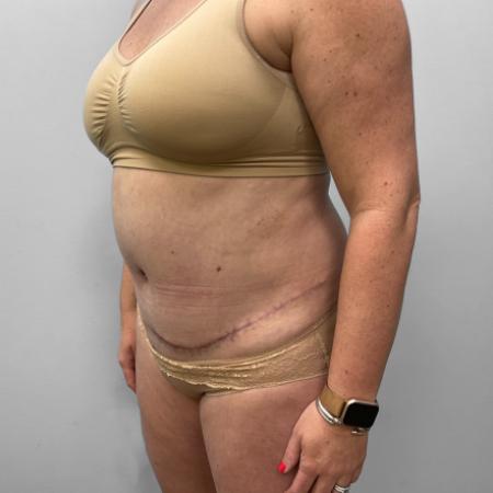 After Case #111416 - Tummy Tuck with Liposuction