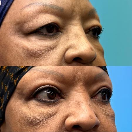 After image 2 Case #111341 - Upper Blepharoplasty