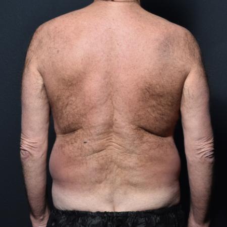 Before image 4 Case #111316 - Tummy Tuck and Liposuction