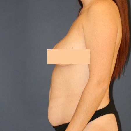 Before image 3 Case #111366 - Tummy Tuck (Abdominoplasty)