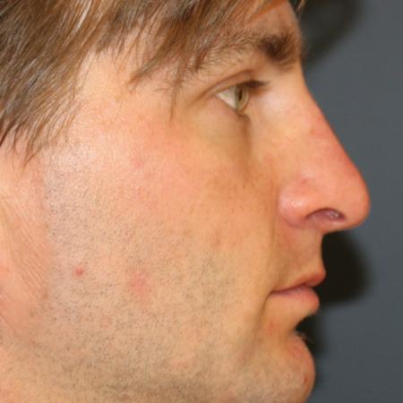 Before image 3 Case #111516 - Male Rhinoplasty with Chin Augmentation