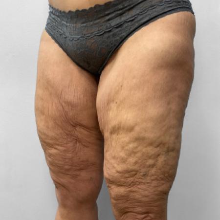 Before Case #111381 - Thigh Liposuction