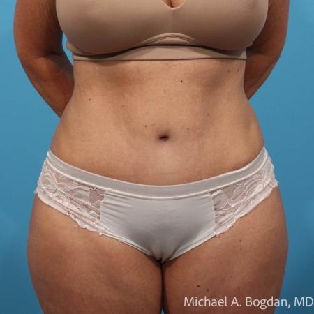 After image 1 Case #111801 - Abdominoplasty