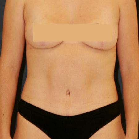 After image 1 Case #111366 - Tummy Tuck (Abdominoplasty)