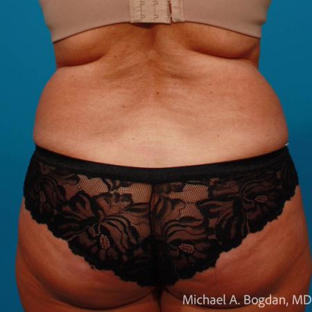 Before image 5 Case #111801 - Abdominoplasty