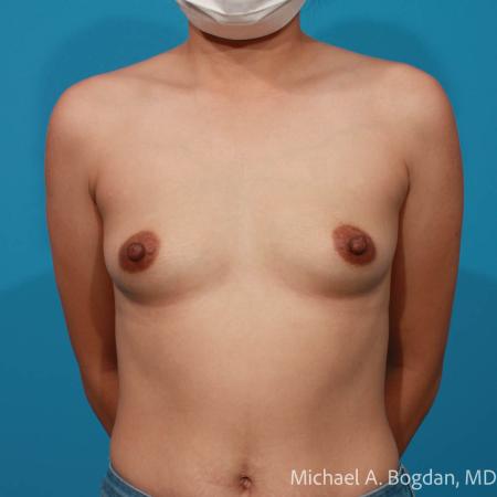Before image 1 Case #111786 - Breast Augmentation