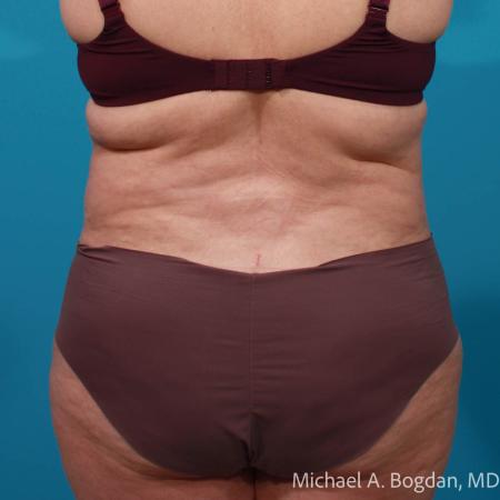 After image 5 Case #111796 - Abdominoplasty