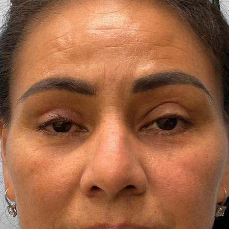 After Case #111856 - Upper and Lower Blepharoplasty