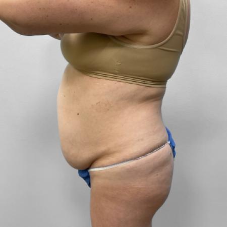 Before Case #111416 - Tummy Tuck with Liposuction