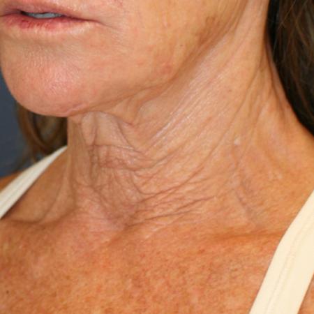 Before image 2 Case #111531 - Female Necklift