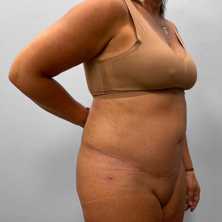 After Case #111431 - Tummy Tuck & Liposuction
