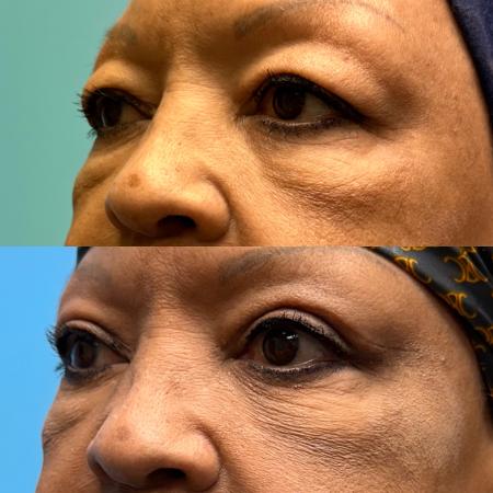 Before image 2 Case #111341 - Upper Blepharoplasty