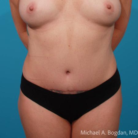 After image 1 Case #111756 - Abdominoplasty