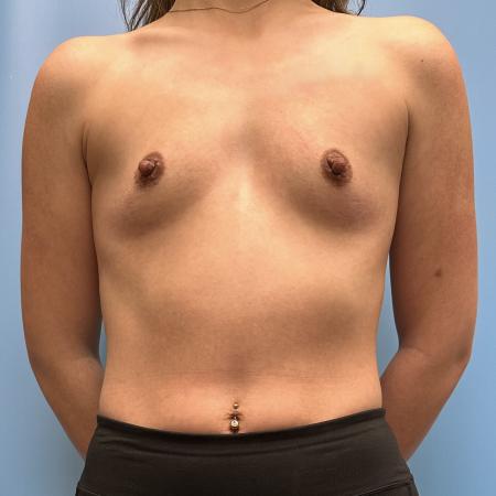 Before image 1 Case #111376 - Breast Augmentation 3