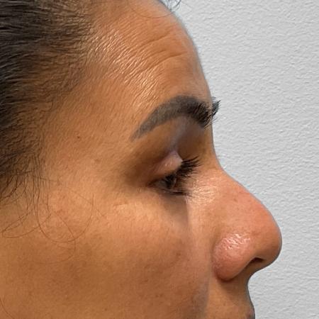 After Case #111856 - Upper and Lower Blepharoplasty