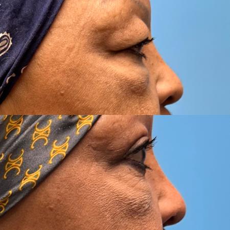 After image 3 Case #111341 - Upper Blepharoplasty