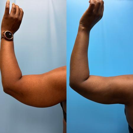 Before image 2 Case #111361 - Arm Liposuction with Renuvion Skin Tightening